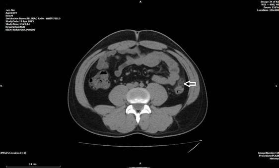 ct scan case of abdomen1 