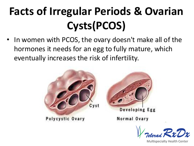 irregular-periods-and-other-facts-PCOS